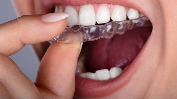 Power and Limitations of Invisalign